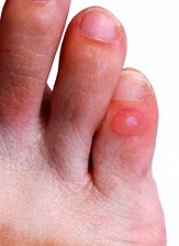 Blisters